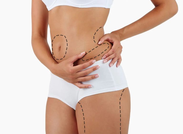 after-liposuction-1